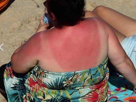 Feeling the burn? Here's how to ease your sunburn as Wakefield basks in 30C heat.