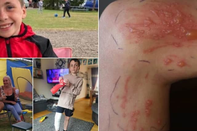 Jayden Bird, nine, rubbed his leg against the toxic weed which is thriving thanks to lockdown. (SWNS)