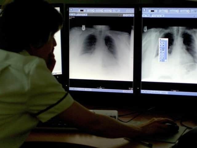 'Worrying' increase in number of people in Wakefield diagnosed with tuberculosis