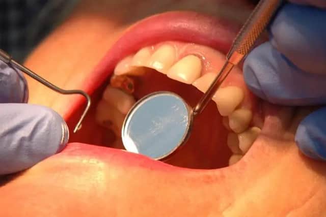 Almost 200 children in Wakefield had decaying teeth removed in hospital during the first year of the coronavirus pandemic.