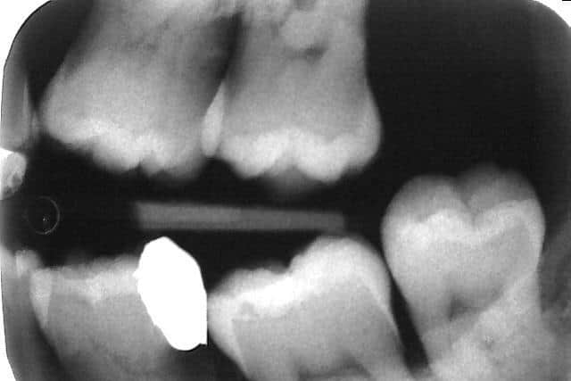 Xray of Adele Waterworth's untreated decay under the filling in lower left first molar