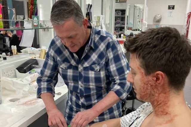 Ryan was left with severe burns after evil Justin Rutherford threw acid at him (Photo: The Mid-Yorks Hospitals NHS Trust)