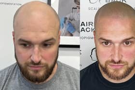 Before and after shows how Hairline Back is pioneering a highly specialised form of medical tattooing to give hair loss sufferers a shaved stubble look
