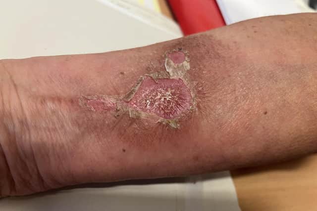 Injury to Sharon's arm following the accident
