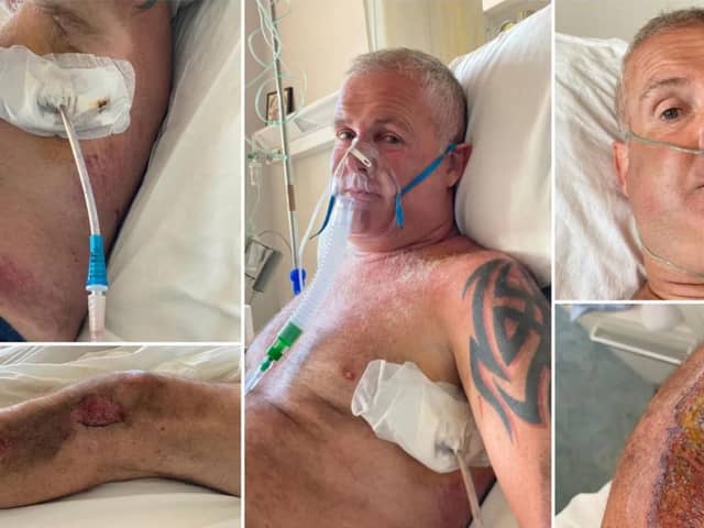 Mark Jepson from Allerton Bywater was injured after falling off a motorbike whilst on holiday in Zante.