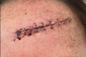 As well as the large gash on her forehead, which required stitches and has left her with a scar, Sam suffered injuries to her leg and arm.