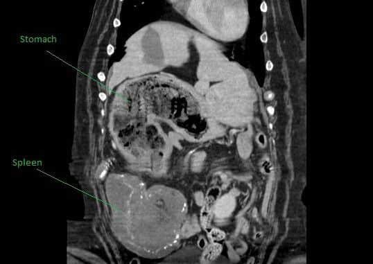 The CT scan showing the mass in Maisys spleen and her full stomach.